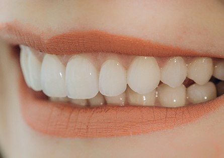 Closeup of a smile with dental crowns in North Dallas 