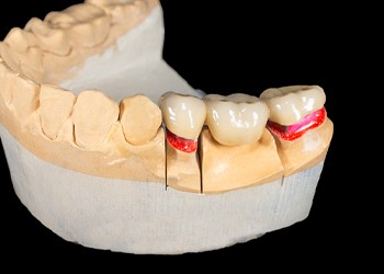 a model of a mouth showcasing a dental bridge and how it works