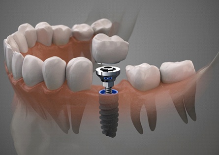Diagram showing how dental implants work in North Dallas