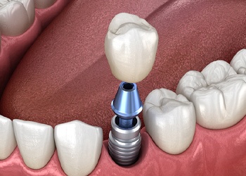 Diagram showing how dental implants work in North Dallas