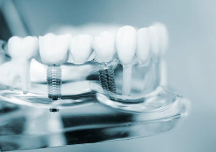 a model of dental implant technology in North Dallas