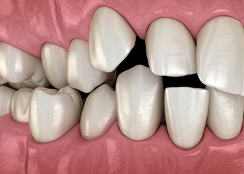 Illustration of gapped teeth