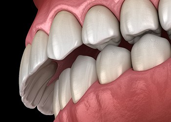 Illustration of an overbite