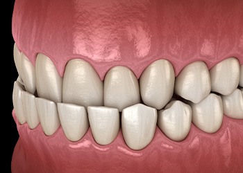 Illustration of an underbite