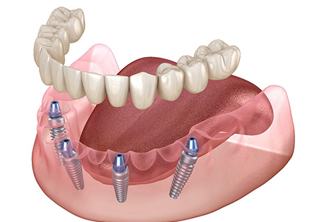 Illustration of an All on 4 implant denture being placed