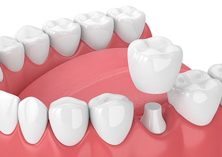 Diagram showing how dental crowns in North Dallas work