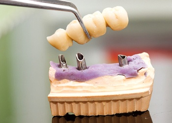 a plaster model of a gumline showing how implant bridges work