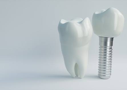 dental implant with crown next to a real tooth