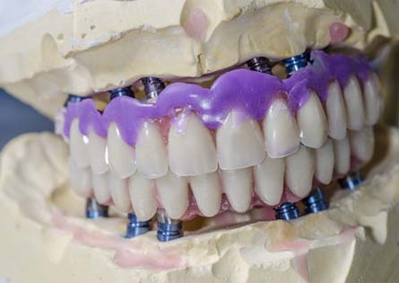 a plaster model of a mouth showing how implant dentures work