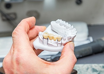  Example of a traditional dental bridge in Dallas