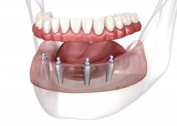 a 3D illustration of an implant denture