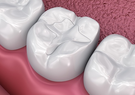 Digital image of a tooth-colored filling
