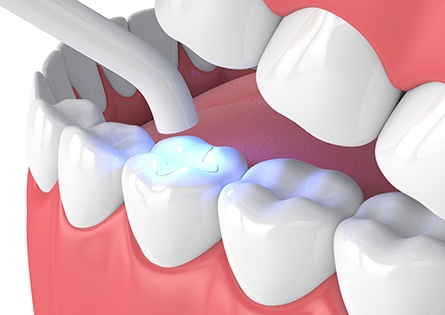Digital image of a curing light hardened a tooth-colored filling