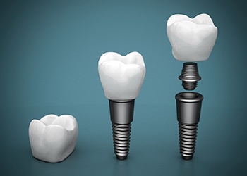 Each component of a single dental implant