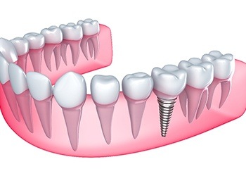 Digital model of a dental implant