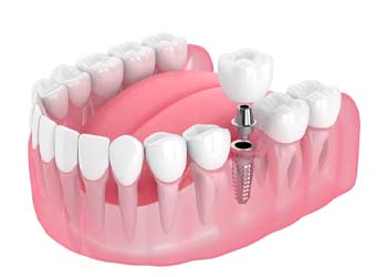 single dental implant with a crown