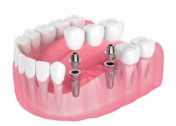 two dental implants with a bridge