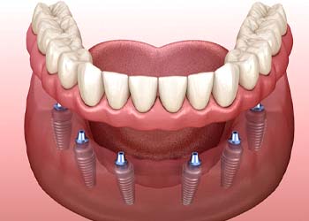 six dental implants with a full denture