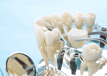 an example of dental implants on a transparent model