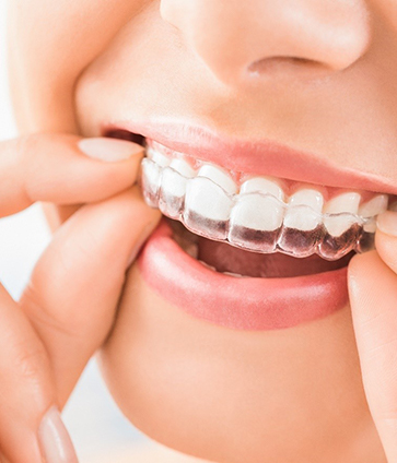 Woman placing Invisalign clear alignment tray