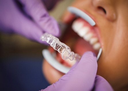 Dentist putting Invisalign trays on patient