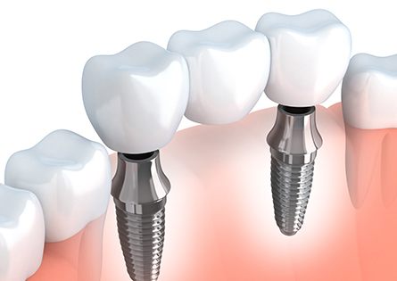 Animated implant supported dental bridge
