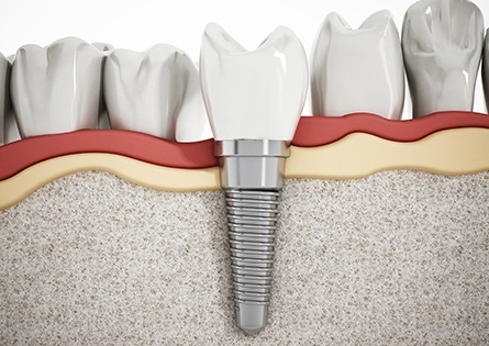 Animated implant supported dental crown