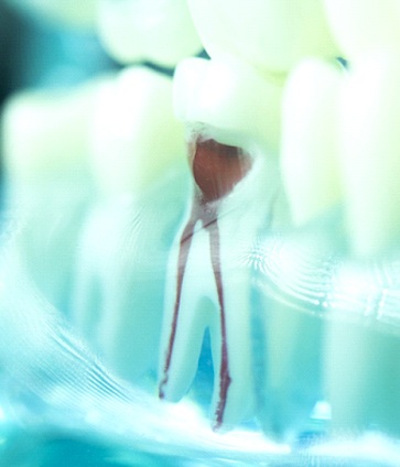 Model of root canal treated tooth