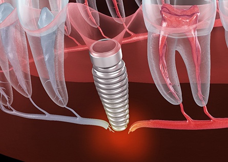 A 3D illustration of a failed dental implant