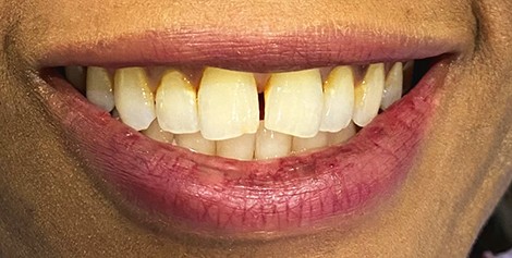 Smile with yellowed slightly gapped teeth