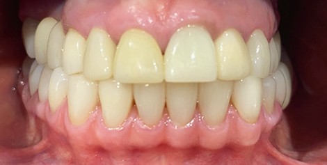 Mouth after removing yellow stains from the teeth