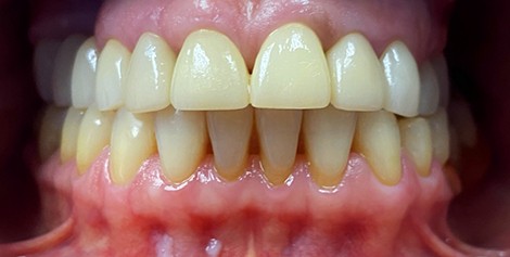 Mouth with yellow stains on several teeth