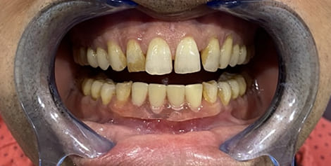 Mouth after replacing missing lower teeth