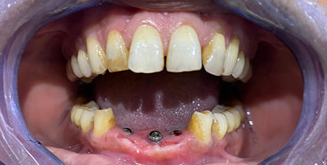 Mouth with several missing lower teeth