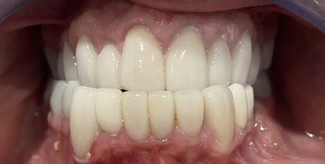 Mouth after whitening the teeth