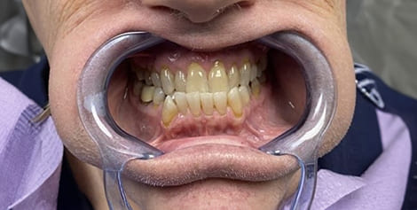Mouth with yellowed teeth