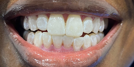 Mouth after whitening the teeth
