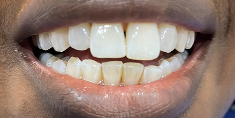 Mouth with yellowed teeth