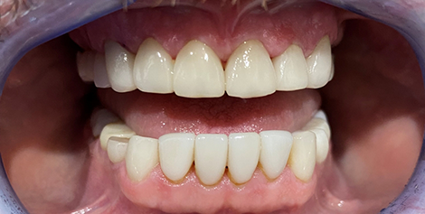Mouth after whitening the teeth