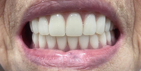 Mouth after whitening the teeth