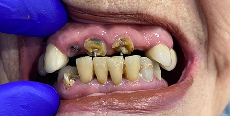 Mouth with yellowed teeth