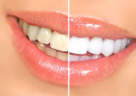 Before and after of teeth whitening treatment