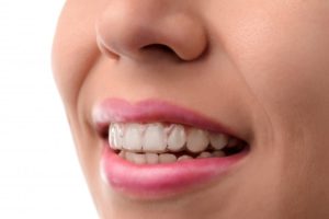 woman smiling wearing Invisalign