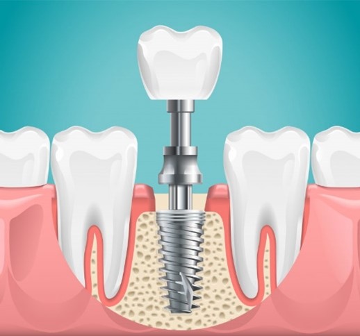 Diagram of dental implants being placed.